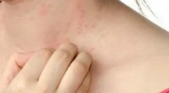 Hogyan lehet megszabadulni a scabies-től: a kezelés módszerei